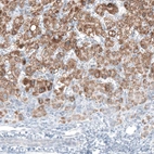 Immunohistochemical staining of human liver cancer shows moderate granular cytoplasmic positivity in tumor cells.