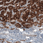 Immunohistochemical staining of human liver cancer shows strong granular cytoplasmic positivity in tumor cells.