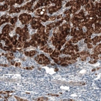 Immunohistochemical staining of human liver cancer shows strong granular cytoplasmic positivity in tumor cells.