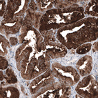 Immunohistochemical staining of human prostate cancer shows strong cytoplasmic positivity in tumor cells.