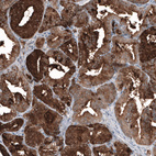 Immunohistochemical staining of human prostate cancer shows strong cytoplasmic positivity in tumor cells.