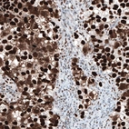 Immunohistochemical staining of human testis cancer, seminoma shows strong nuclear positivity.