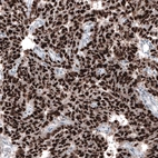 Immunohistochemical staining of human human embryonal carcinoma of testis shows strong nuclear positivity.