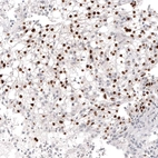 Immunohistochemical staining of human renal cancer shows moderate nuclear positivity in tumor cells.