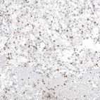 Immunohistochemical staining of human renal cancer shows moderate cytoplasmic positivity in lymphoid cells.