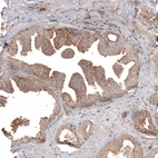Immunohistochemical staining of human prostate cancer shows moderate cytoplasmic positivity in glandular cells.
