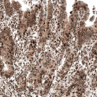 Immunohistochemical staining of human stomach cancer shows moderate to strong nuclear positivity.