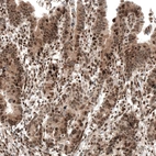 Immunohistochemical staining of human stomach cancer shows moderate to strong nuclear positivity.