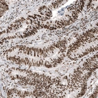 Immunohistochemical staining of human colorectal cancer shows strong nuclear positivity in tumor cells.