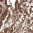 Immunohistochemical staining of human stomach cancer shows strong cytoplasmic and nuclear positivity.