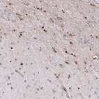 Immunohistochemical staining of human cerebral cortex (Alzheimer disease) shows moderate cytoplasmic positivity in microglia.
