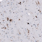 Immunohistochemical staining of human cerebral cortex (Alzheimer disease) shows moderate to strong cytoplasmic positivity in microglia.