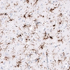 Immunohistochemical staining of human cerebral cortex (Alzheimer disease) shows strong cytoplasmic positivity in microglia.