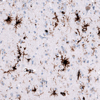 Immunohistochemical staining of human cerebral cortex (Alzheimer disease) shows strong cytoplasmic positivity in microglia.