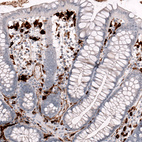 Immunohistochemical staining of human colon shows strong cytoplasmic positivity in lymphoid cells.