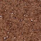 Immunohistochemical staining of human oligodendroglioma shows strong cytoplasmic and nuclear positivity in tumor cells.