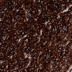 Immunohistochemical staining of human glioblastoma multiforme shows strong positivity in tumor cells.