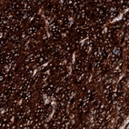 Immunohistochemical staining of human glioblastoma multiforme shows strong positivity in tumor cells.