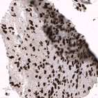 Immunohistochemical staining of human glioblastoma multiforme shows strong nuclear positivity in tumor cells.