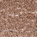 Immunohistochemical staining of human oligodendroglioma shows strong nuclear positivity in tumor cells.