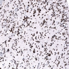 Immunohistochemical staining of human glioblastoma multiforme shows strong nuclear positivity in tumor cells.