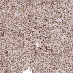Immunohistochemical staining of human oligodendroglioma shows moderate to strong nuclear positivity in tumor cells.