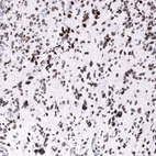 Immunohistochemical staining of human glioblastoma multiforme shows strong nuclear positivity in tumor cells.