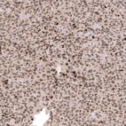 Immunohistochemical staining of human oligodendroglioma shows moderate to strong nuclear positivity in tumor cells.