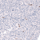 Immunohistochemical staining of human anaplastic oligodendroglioma shows strong cytoplasmic positivity in a subset of cells.