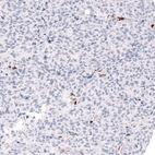 Immunohistochemical staining of human anaplastic oligodendroglioma shows strong cytoplasmic positivity in a subset of cells.