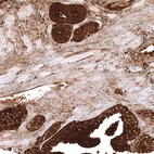 Immunohistochemical staining of human prostate cancer shows strong cytoplasmic positivity in tumor cells.