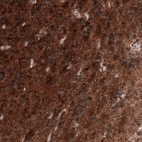 Immunohistochemical staining of human glioblastoma multiforme shows strong positivity in tumor cells.
