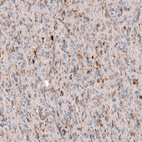 Immunohistochemical staining of human astrocytoma shows moderate positivity in tumor cells.