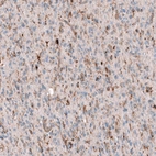 Immunohistochemical staining of human astrocytoma shows moderate positivity in tumor cells.