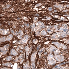 Immunohistochemical staining of human breast cancer shows strong positivity in extracellular matrix.