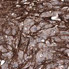 Immunohistochemical staining of human breast cancer shows strong positivity in extracellular matrix.
