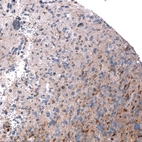 Immunohistochemical staining of human glioblastoma shows moderate to strong positivity.