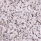 Immunohistochemical staining of human astrocytoma shows strong nuclear positivity in tumor cells.
