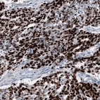 Immunohistochemical staining of human testis cancer (embryonal carcinoma) shows strong nuclear positivity in tumor cells.