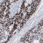 Immunohistochemical staining of human testis cancer (embryonal carcinoma) shows strong nuclear positivity in tumor cells.