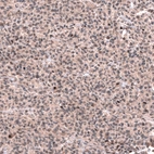 Immunohistochemical staining of human oligodendroglioma shows moderate nuclear positivity in a subset of tumor cells.