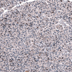 Immunohistochemical staining of human oligodendroglioma shows moderate nuclear positivity in a subset of tumor cells.