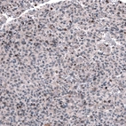 Immunohistochemical staining of human oligodendroglioma shows moderate nuclear positivity in a subset of tumor cells.