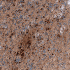 Immunohistochemical staining of human glioblastoma shows moderate to strong cytoplasmic positivity in tumor cells.
