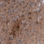 Immunohistochemical staining of human glioblastoma shows moderate to strong cytoplasmic positivity in tumor cells.
