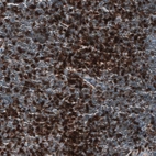 Immunohistochemical staining of human chronic lymphocytic leukemia shows strong membranous positivity in tumor cells.