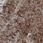 Immunohistochemical staining of human ovarian cancer (papillary carcinoma) shows strong cytoplasmic positivity in tumor cells.