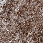 Immunohistochemical staining of human ovarian cancer (papillary carcinoma) shows strong cytoplasmic positivity in tumor cells.