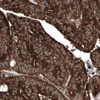 Immunohistochemical staining of human colorectal cancer (metastasis to ovary) shows strong cytoplasmic positivity in tumor cells.