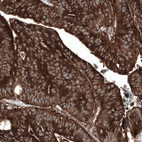 Immunohistochemical staining of human colorectal cancer (metastasis to ovary) shows strong cytoplasmic positivity in tumor cells.